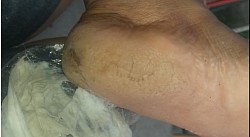 Antes rachaduras profundas