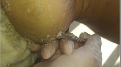 Retirada de pele morta