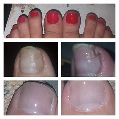 Reconstrução de Unha